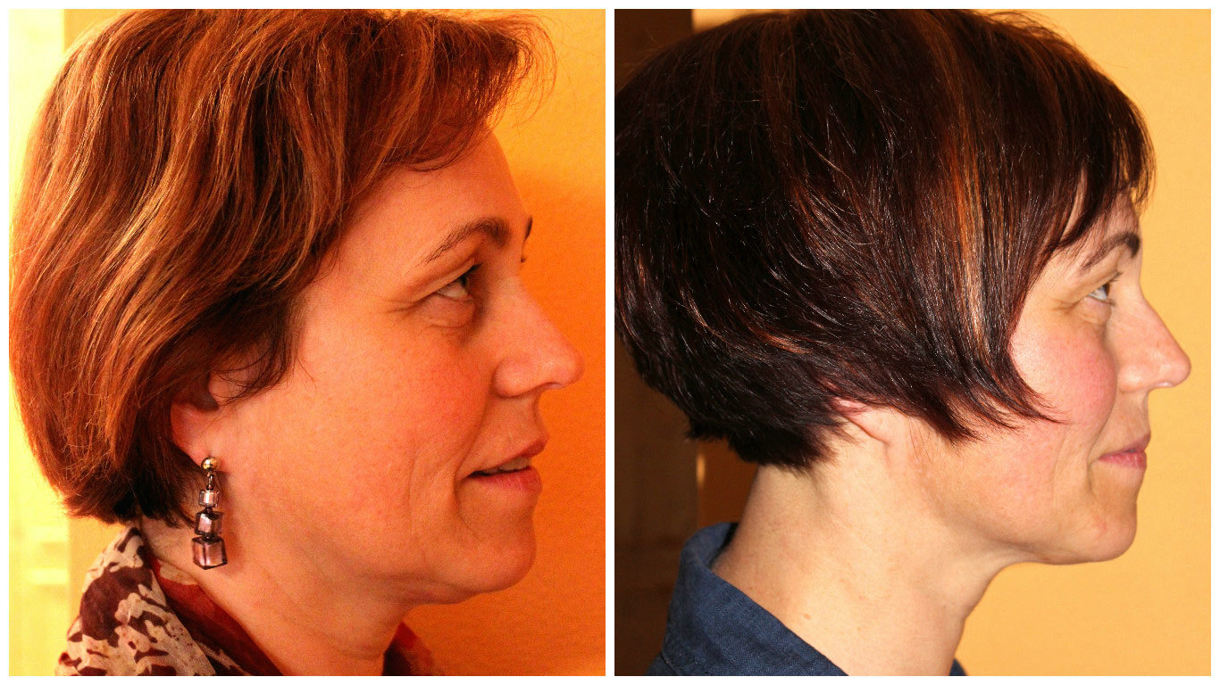 vorher_nachher_seitlich_chistattbotox Chi statt Botox