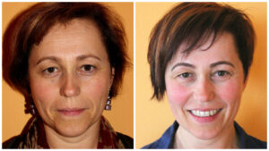 vorher_nachher_vorne_chi-statt-botox-1.jpg
